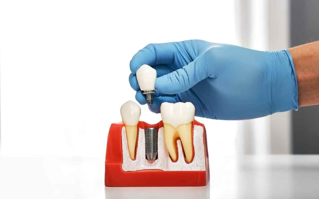 Top Tips for Maintaining Long-Lasting Dental Implants