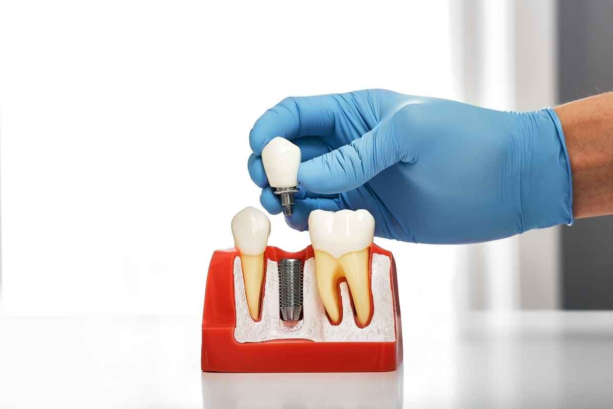 Long Lasting Dental Implants