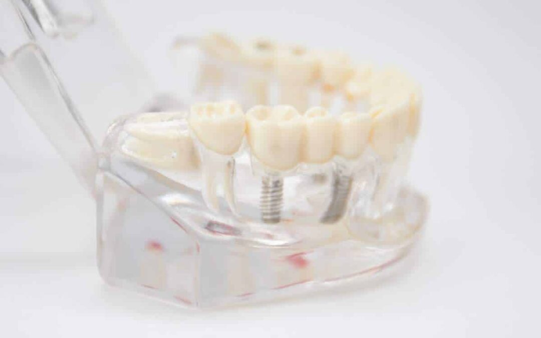 Daily Care Tips For Maintaining All-on-4 Dental Implants