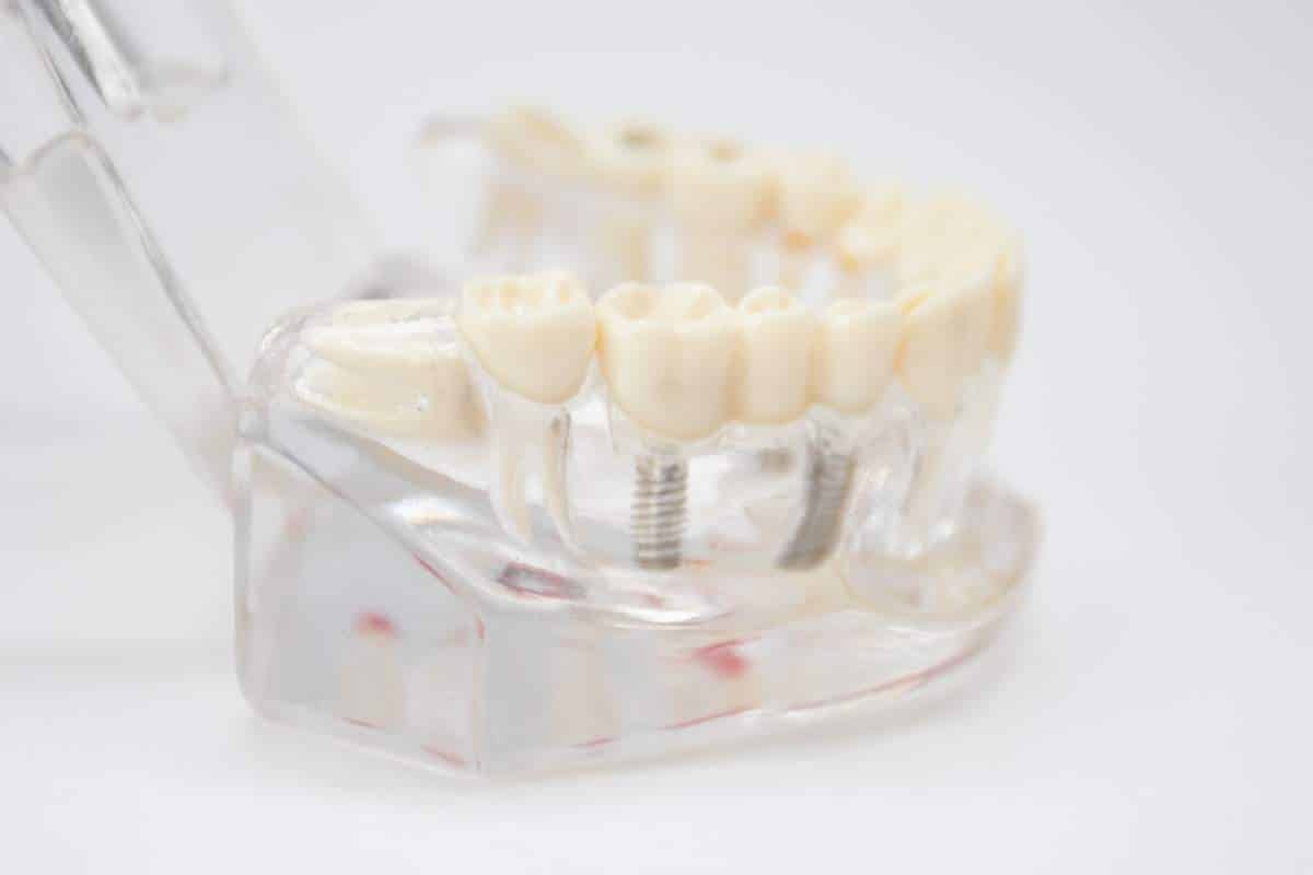 Dental model showing teeth arrangement with orthodontic brackets and wire in clear display case.
