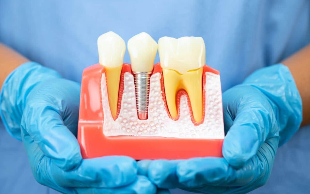 Why Dental Implants Are Long-Term Tooth Replacement Solutions For Missing Teeth?