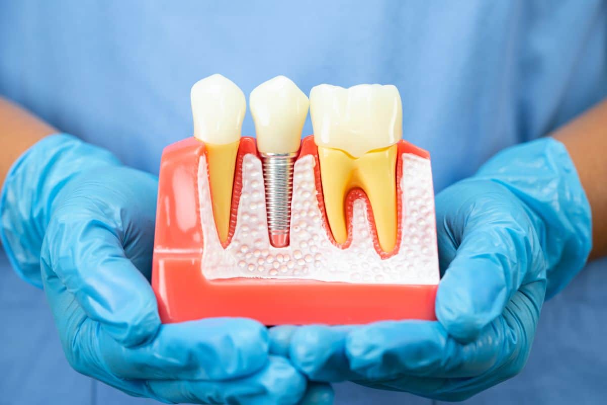 considering dental implants in Chandler