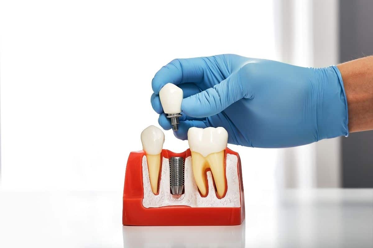 Dental Implants