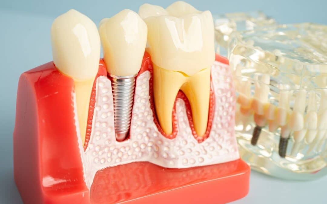 Dental Implants vs. Dentures: Which Tooth Replacement Option Is Right for You?