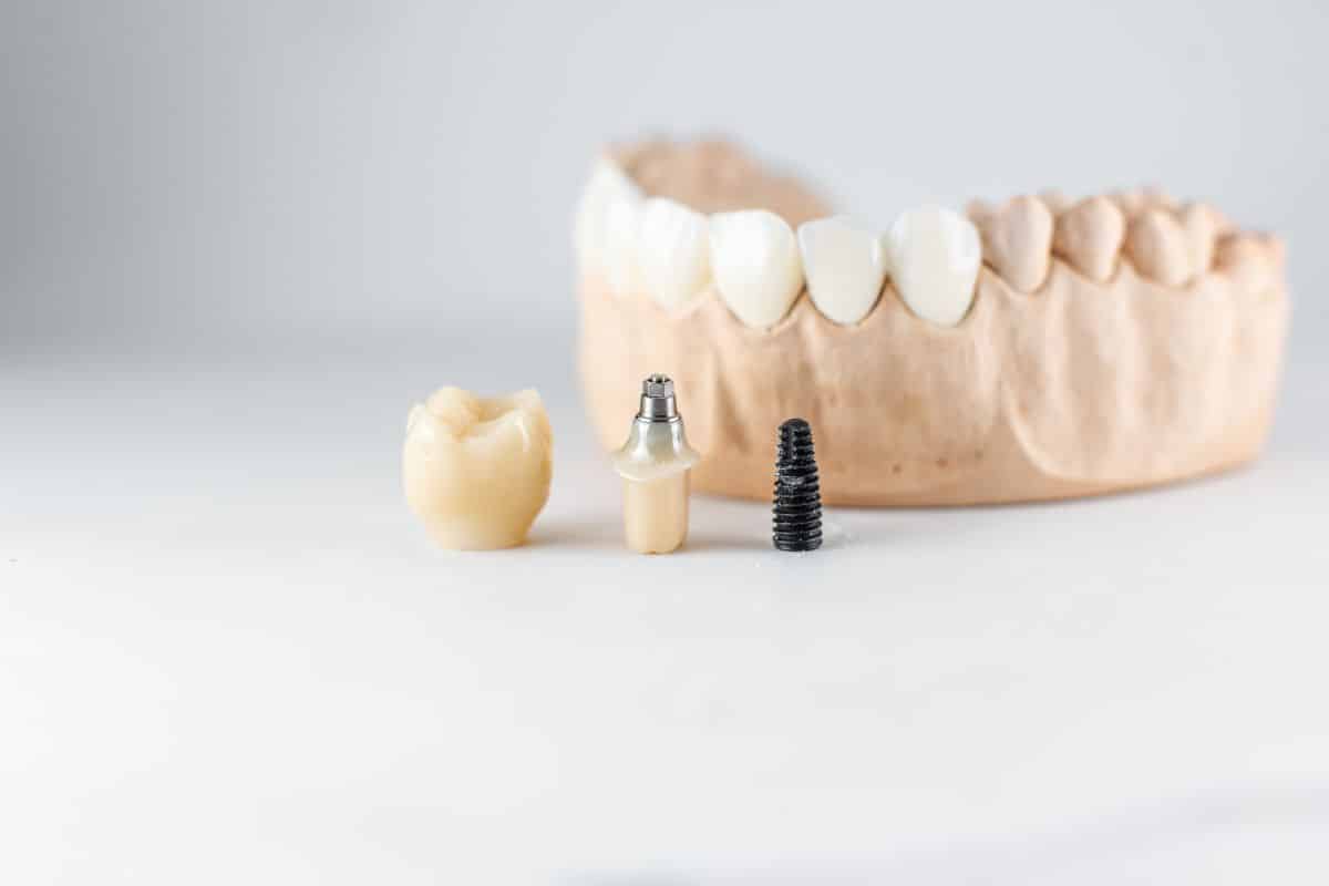 Dental Implant Dental implants chandler