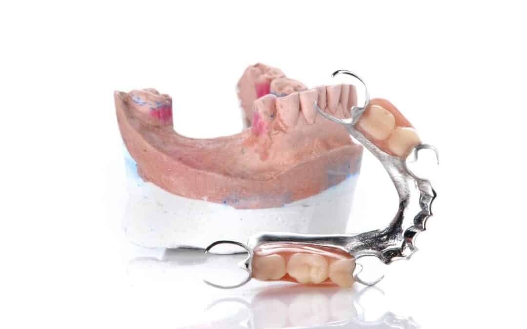 Partial Denture: A Simple Solution for Replacing Missing Teeth